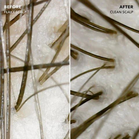 DANDRX Anti Dandruff Shampoo and Conditioner with 2% Pyrithione Zinc and Stem Cells | Physician Founded for Itchy Scalp | Eliminates Flakes & Fights Dandruff | Color Safe, Sulfate Free, Paraben Free