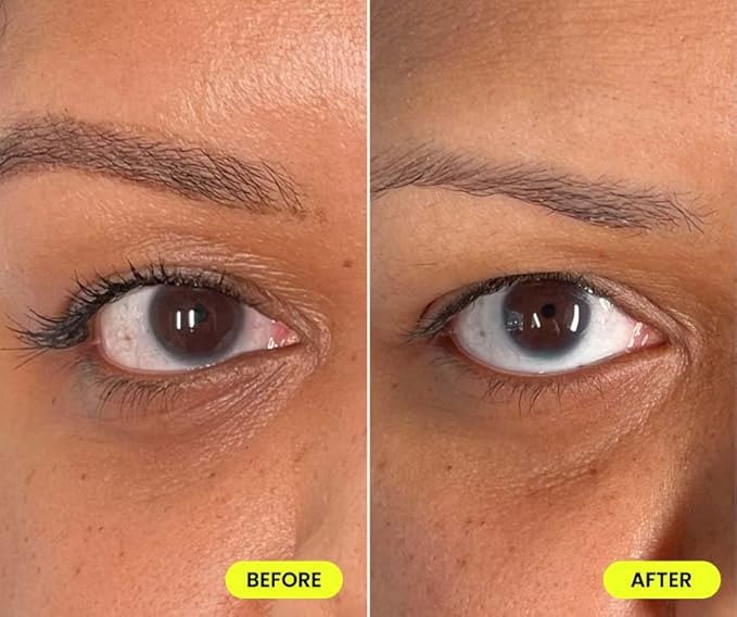 Urban Skin Rx® Dark Circle Vitaleyez Nighttime Eye Treatment Cream, Smooths & Brightens the Look of Tired Puffy Under-Eyes, Targets Dark Circles & Fine Lines with Caffeine & Hyaluronic Acid, 0.5 Oz