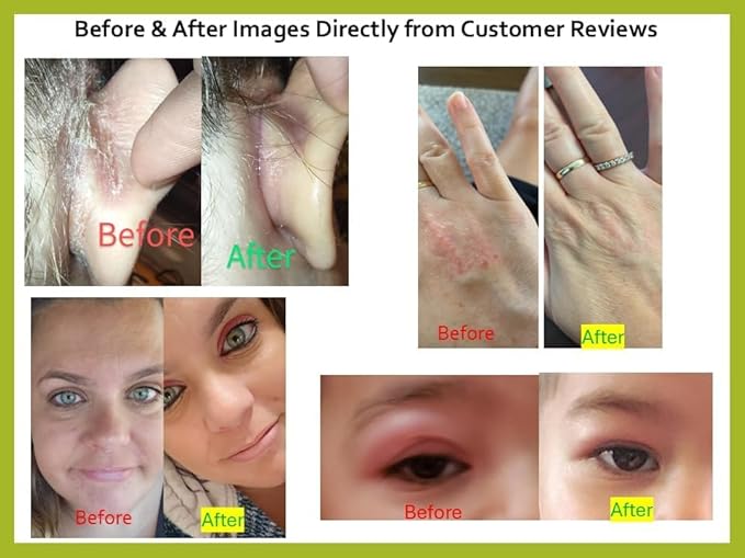 Tea Tree Oil Balm, Itchy Skin Relief for Soothing Rashes, Jock Itch, Athlete’s Foot, Folliculitis, Bug Bites. Natural Formula for Dry Sensitive Skin | Safe for All Ages 1pack