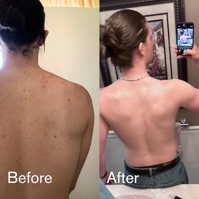 Shield Body Acne Wash for Men and Boys – Unscented Back & Chest Cleanser, Clears Acne & Breakouts, 8.5 oz, Pack of 2