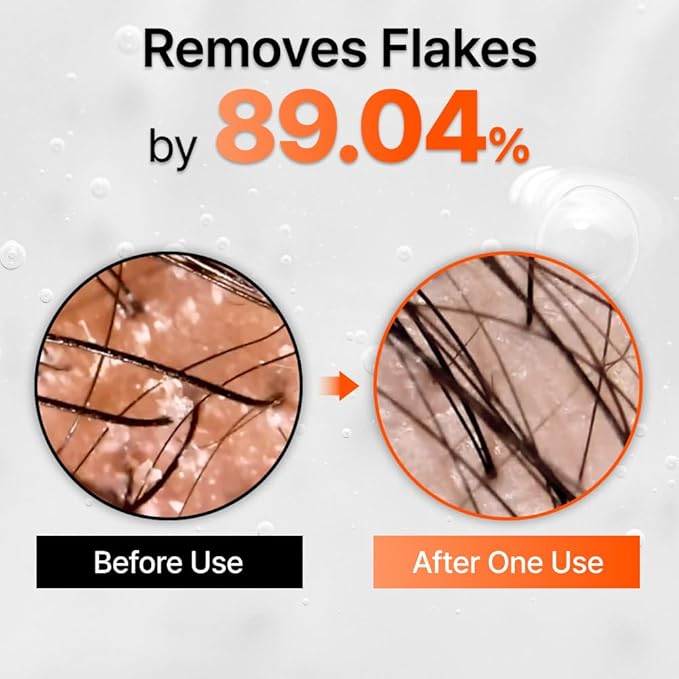 lilyeve GROWTURN Hair Growth Serum with Built-in Brush, Heartleaf-Derived Exosomes to Revitalize Hair, Hair Thickening, Hair Growth Accelerator - Korean Hair Care, 3.38 fl. oz. (Pack of 1)