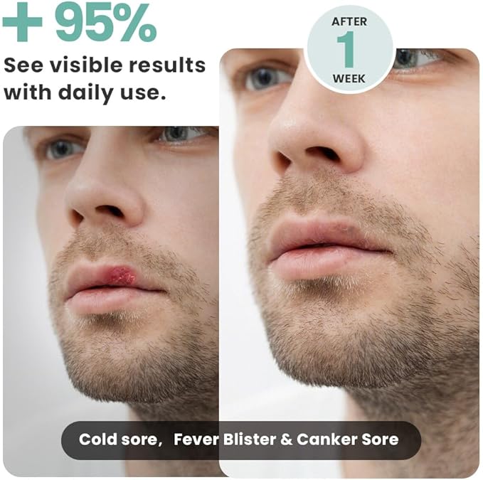 Red Light Therapy for Face, Cold Sore Device Red Light Therapy Wand, FSA-HSA Rechargeable Elite Grade Infrared Light Therapy, Red Light Therapy Cold Sore Device, Ideal for Lips, Skin, Face.