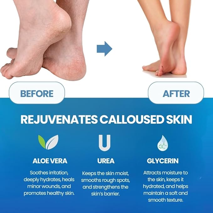 Imperial Feet - Callus Remover for Feet Extra Strenght - Callus Removers for Feet and Toes