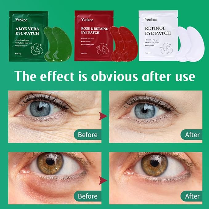 Yeokoe Under Eye Patches For Puffy Eyes and Dark Circles Wrinkle,30 Pairs Face Masks SkinCare With Retinol Serum,Aloe Vera,Rose Betaine