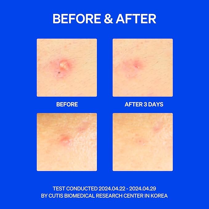 Right Away Thincognito Invisible Spot Patch - Absorbing Hydrocolloid Pimple Patch for Face, Blemishes, Zits, Acne, Breakouts Spot Treatment for Skin Care, 2 Sizes (42 Count Pack of 2)