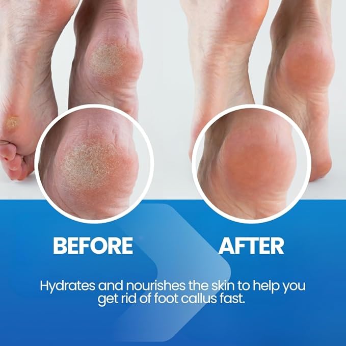 Imperial Feet - Callus Remover for Feet Extra Strenght - Callus Removers for Feet and Toes