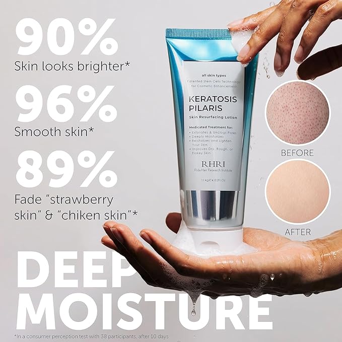 Keratosis Pilaris Treatment | Keratosis Pilaris Lotion with 10% AHA | Gentle Exfoliation For Strawberry Legs, KP & Ingrown Hairs | Smooth & Hydrating Body Lotion For Redness, Dry, Rough And Flaky Skin
