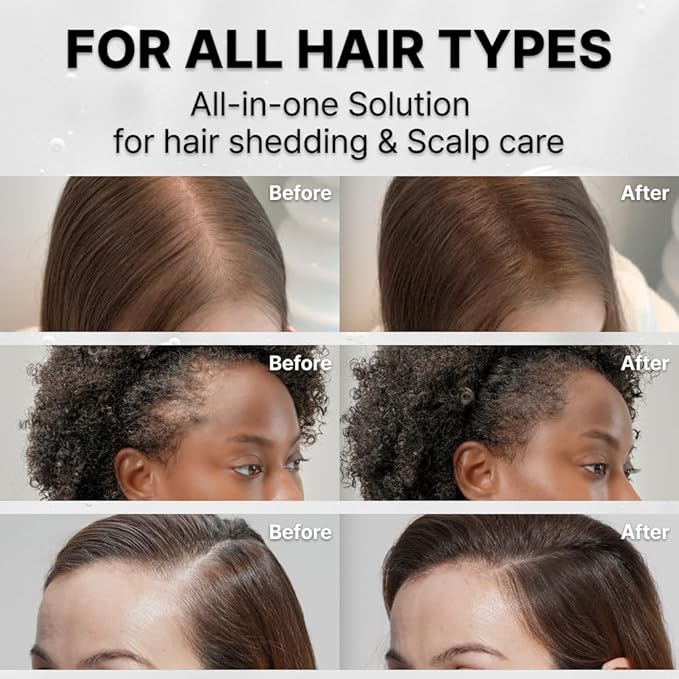 lilyeve GROWTURN Hair Growth Serum with Built-in Brush, Heartleaf-Derived Exosomes to Revitalize Hair, Hair Thickening, Hair Growth Accelerator - Korean Hair Care, 3.38 fl. oz. (Pack of 4)