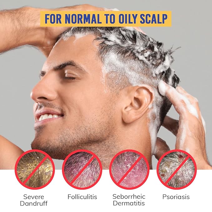 Seborrheic Dermatitis Folliculitis Dandruff Shampoo - Anti Fungal Medicated Shampoo for Healthy Scalp with Selenium Sulfide & Botanical Extracts - Flakes Itchy and Oily Scalp Relief Stop Hair Loss