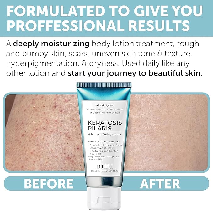 Keratosis Pilaris Treatment | Keratosis Pilaris Lotion with 10% AHA | Gentle Exfoliation For Strawberry Legs, KP & Ingrown Hairs | Smooth & Hydrating Body Lotion For Redness, Dry, Rough And Flaky Skin