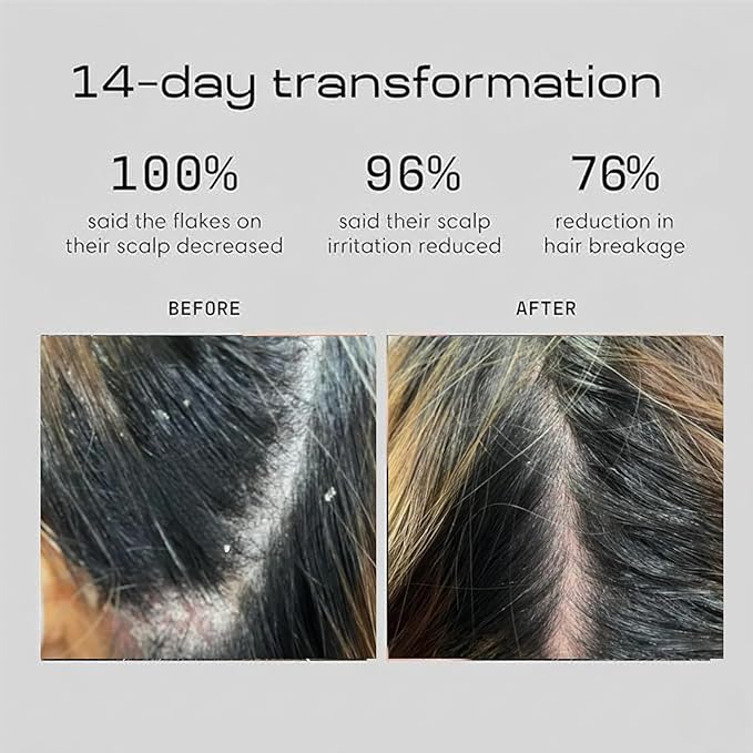 DANDRX Anti Dandruff Shampoo and Conditioner with 2% Pyrithione Zinc and Stem Cells | Physician Founded for Itchy Scalp | Eliminates Flakes & Fights Dandruff | Color Safe, Sulfate Free, Paraben Free