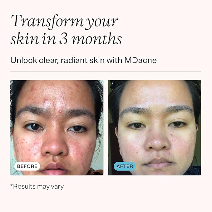 MDacne 3 Step Face Acne Treatment Kit, Benzoyl Peroxide Cream 2.5%, Salicylic Acid Cleanser, Niacinamide Moisturizer – Medicated Plant-Based Skincare for Adult & Teen Acne, 60 Day Kit