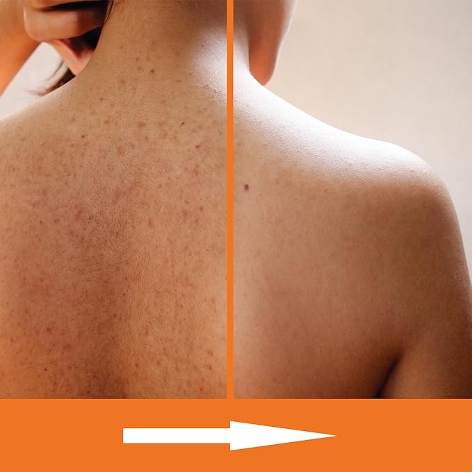 KERAPIL Salicylic Acid Body Wash - Skin Non-drying, Gentle Exfoliates Rough and Bumpy Skin, Body Acne Wash, BHA & AHA - Unscented Exfoliating Body Wash, Made in USA - (16 fl oz x 2)