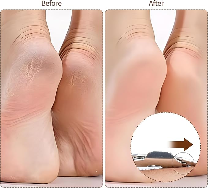 Callus Shaver with Wooden Handle，Pedicure Foot File Kit，Foot File Callus Remover，High-Quality Scraper for Removing Calluses, Cracked Heels, and Dead Skin
