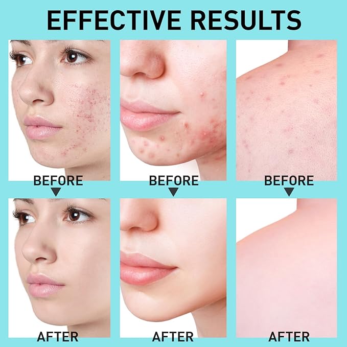 Salicylic Acid Acne Spot Treatment: Cystic Hormonal Pimple Cream for Stubborn Zits, Blemish Breakout & Post-Acne Scars - Face, Body & Back, Teens-Adults, 1.8 oz