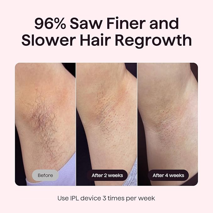 Wavytalk IPL Hair Removal Device, Bare It for Face Body Bikini – Long-Lasting Result & Painless,Full Body in 12 Mins with 24J Dual-Pulse & Ice Cooling, At-Home Use for Women and Men, Corded