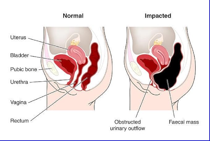 Miracle Oxy-Colon 2 Day Colon Cleanser and Detox - Total Body Cleanser - Intestinal Cleanser - Voted #1