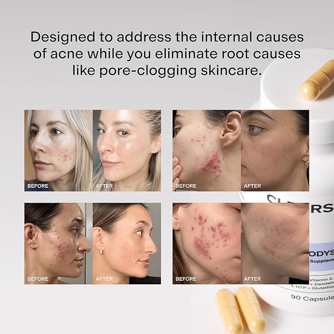 CLEARSTEM - MINDBODYSKIN Hormonal Acne Supplement (5-HTP) - Natural DIM Supplement - Skin Care Vitamins - Hormone Balance, Antioxidants - Gluten Free, Cruelty Free - 30 Servings, 90 Capsules