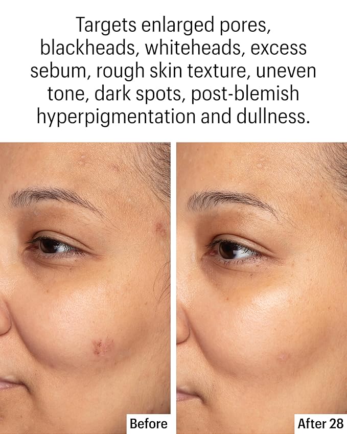 Allies of Skin Azelaic & Kojic Clarifying Face Serum | Clinically Proven for Acne & Blemish Prone Skin |10% Azelaic Acid Treats Pigmentation and Redness | Targets Pores & Uneven Skin Texture (1 Fl oz)