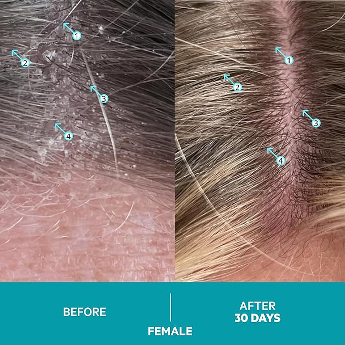 DS Labs Dandrene Dandruff Shampoo, 205mL - for Flaky, Itchy Scalp, Exfoliating Shampoo for Dry Scalp, Seborrheic Dermatitis & Scalp Psoriasis, Color Safe, Sulfate Free, (2 Pack)