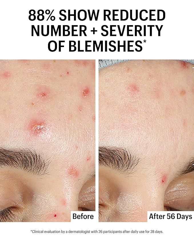 Allies of Skin Azelaic & Kojic Clarifying Face Serum | Clinically Proven for Acne & Blemish Prone Skin |10% Azelaic Acid Treats Pigmentation and Redness | Targets Pores & Uneven Skin Texture (1 Fl oz)