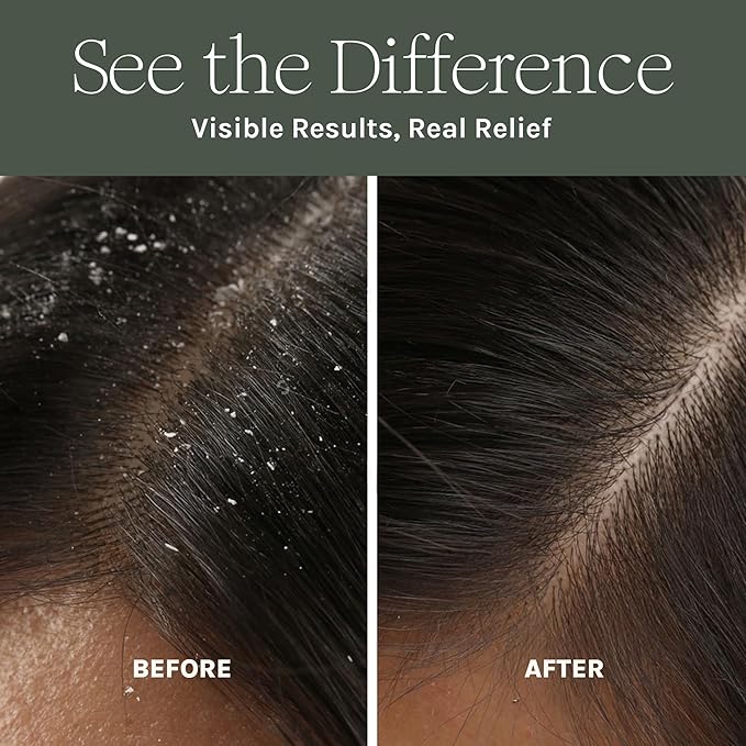 Antifungal Antibacterial Scalp Mask – Boost Hair Growth – Natural Detoxifying Treatment – Nourish with Aloe, Neem, Rosemary, Apple Cider Vinegar & Black Seed – Sulfate, Paraben, Phthalate Free