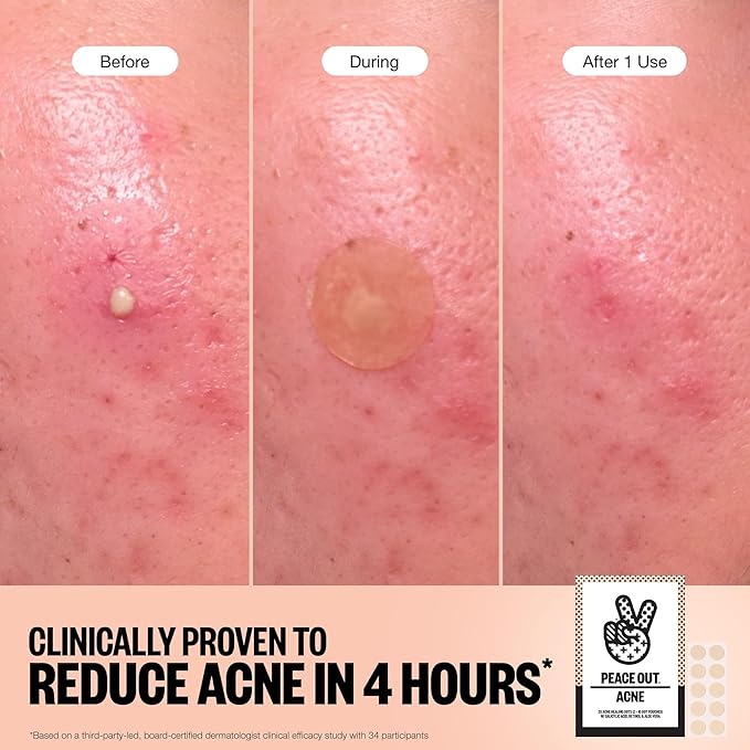 PEACE OUT Acne Healing Dots Hydrocolloid Pimple Patches, Acne Spot Treatment with Salicylic Acid, Retinol, and Aloe Vera for Blemishes and Breakouts, 20 Count