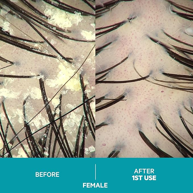 DS Labs Dandrene Dandruff Shampoo, 205mL - for Flaky, Itchy Scalp, Exfoliating Shampoo for Dry Scalp, Seborrheic Dermatitis & Scalp Psoriasis, Color Safe, Sulfate Free, (2 Pack)