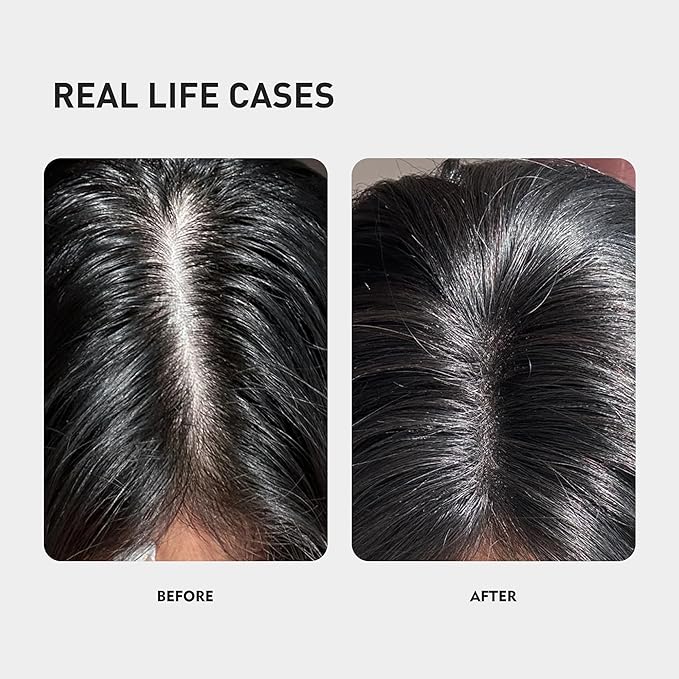 0.5% KINTOR KX-826 Hair Growth Spray,Oil Control Strengthen Hair,Hair Regrowth Products for Women&Men,Basic,60ml