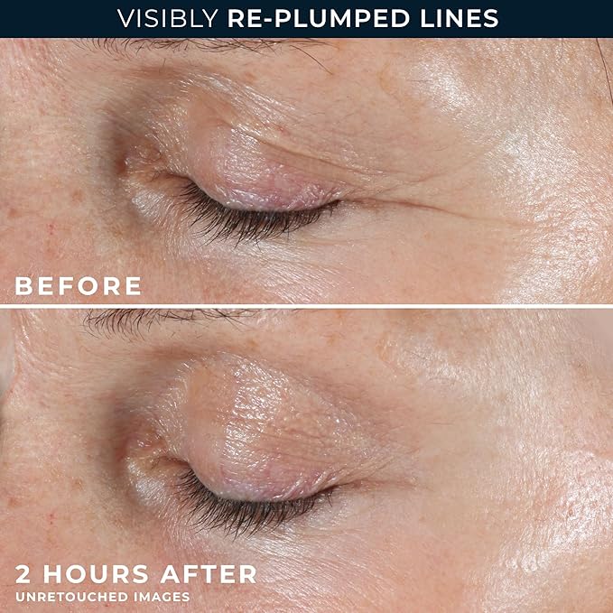 RoC Retinol Correxion Deep Wrinkle Non-Invasive Targeted Patches with Hyaluronic Acid + Firming Peptides for Forehead, 11 Lines, Crow’s Feet and Laugh Lines, (6 Patches) with Retinol Eye Packette