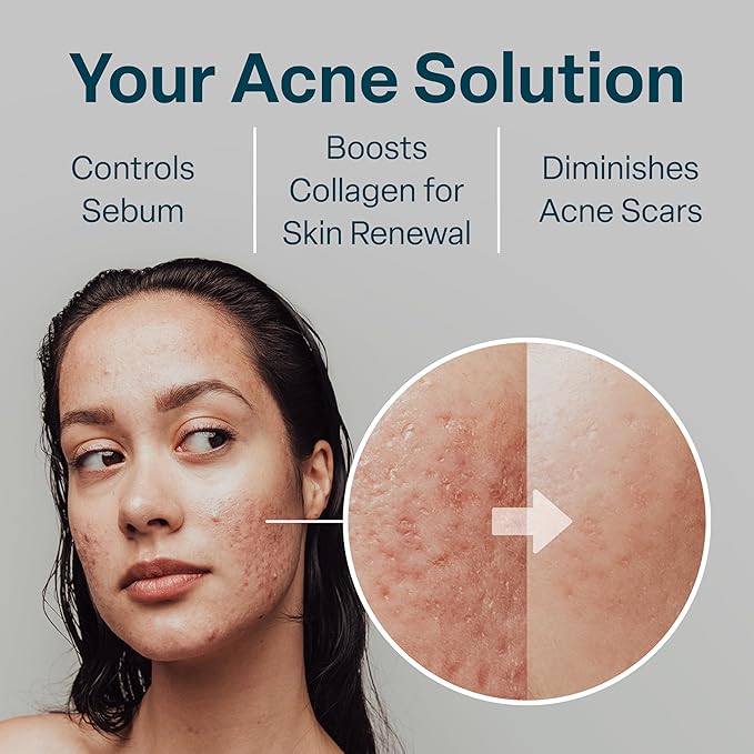 QRxLabs Salicylic & Glycolic Acid Acne Clearing Pads - 2% Salicylic & 10% Glycolic Acid - Exfoliating Pads for Acne, Bacne, Butt Acne, Body Acne - Daily Pads - 50ct