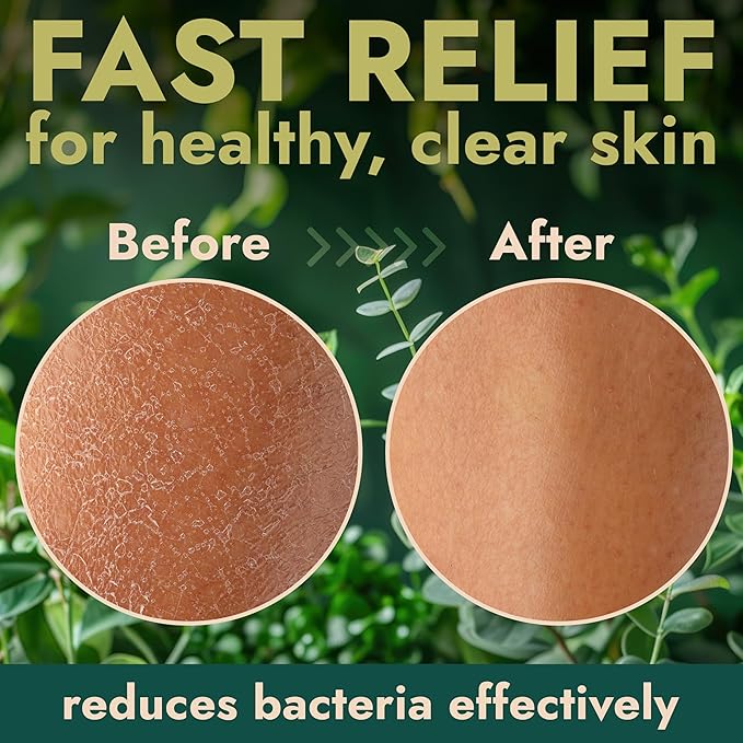 Antibacterial Body Wash | Antibacterial Soap for Men & Women | Kills 99.9% of Germs & Bacteria | Helps with Back Acne, Body Odor & Skin Irritation | Manuka Honey & Charcoal, 16 fl oz