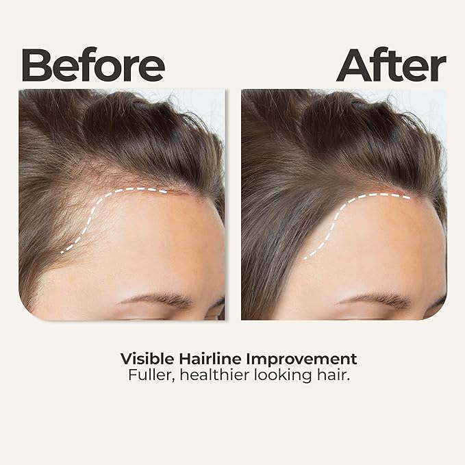 Rosemary Oil for Hair Growth + Head Massager Set | Strengthening Biotin + Coconut Oil – Hair Thickening Serum – Dry, Frizzy, Split Ends & Damaged Scalp Treatment – Color Safe, All Hair Types