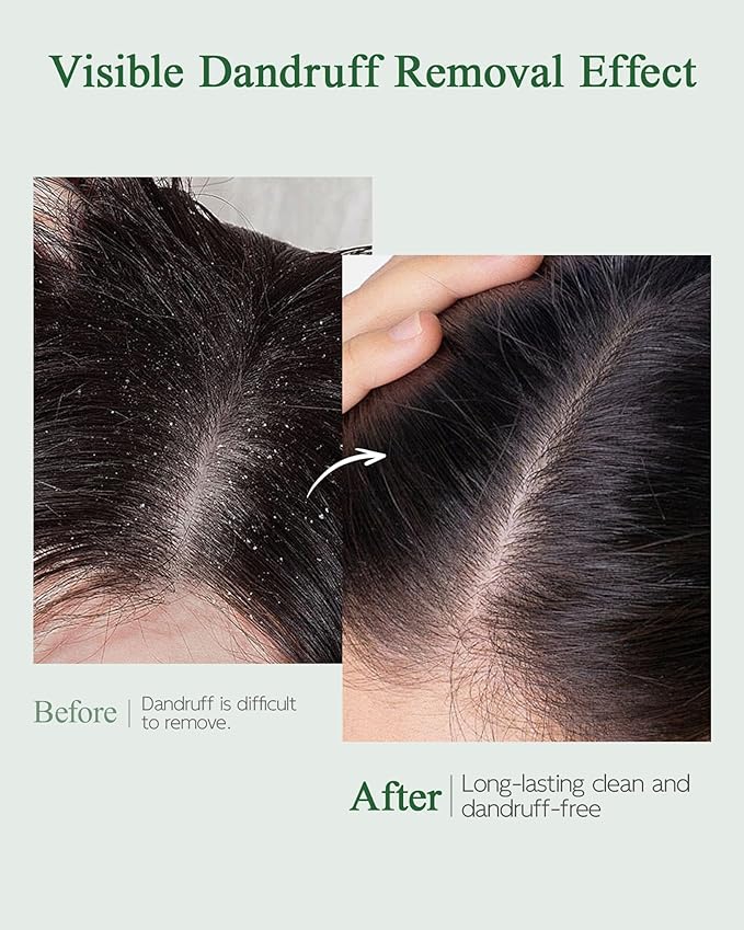 Mugwort Pre-Shampoo Scalp Serum, Anti-Dandruff & Soothing Cleansing Essence with Built-in Brush, Moisturizing Amino Acid Formula to Balance Scalp Barrier, Relieve Itching & Flakes