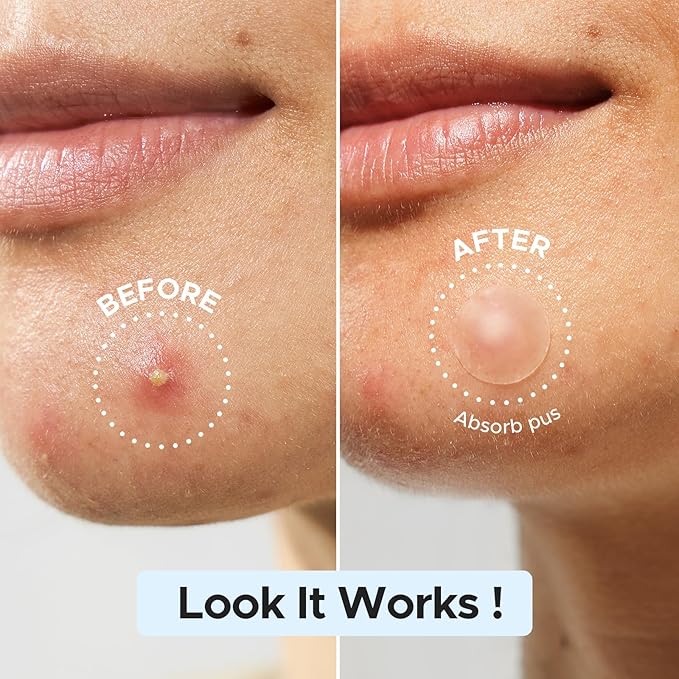 LitBear Pimple Patch Bulk, 720 Patches 3 Size Acne Patches for Face, Hydrocolloid Spot Stickers for Covering Zits, Blemishes, and Breakouts, Suitable for All Skin Types