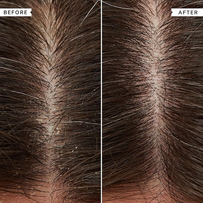 Flaky Scalp Shampoo and Conditioner Set for Dry Scalp Cleansing Hair Products Soothing, Soothes and Calms